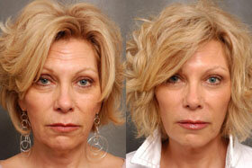 Figure 1 before and after application of Goji Cream