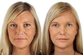 Figure 2 before and after application of Goji Cream