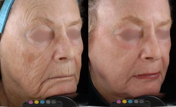 photograph before and after laser rejuvenation
