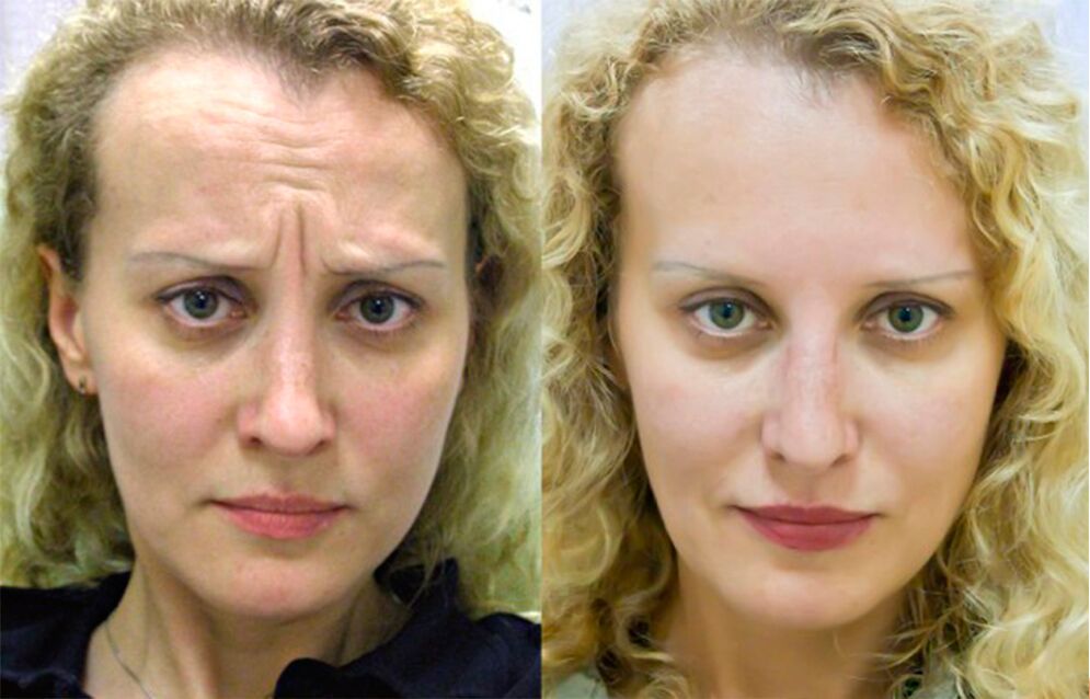 before and after using a masseur for rejuvenation ltza Figure 1