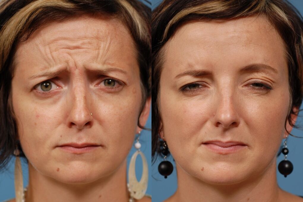before and after using a masseur for rejuvenation ltza Figure 2