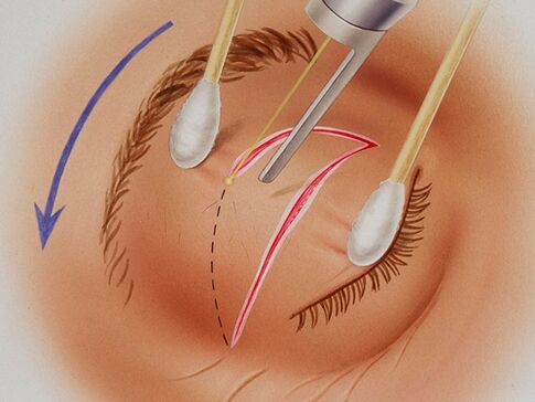 laser rejuvenation of the eyelids