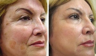 Fractional skin rejuvenation before and after pictures
