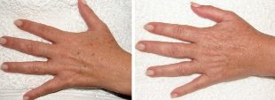 The result of the removal of wet spots on the hands