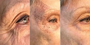 photographs before and after plasma skin rejuvenation